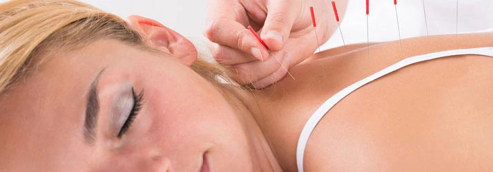 Acupuncture Firestone CO Acupuncture Pricing Acupuncture Firestone CO Acupuncture Pricing