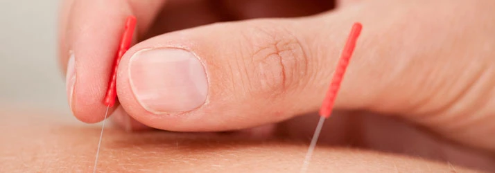 Chiropractic Firestone CO Dry Needling Chiropractic Firestone CO Dry Needling